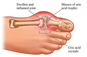 what-is-gout
